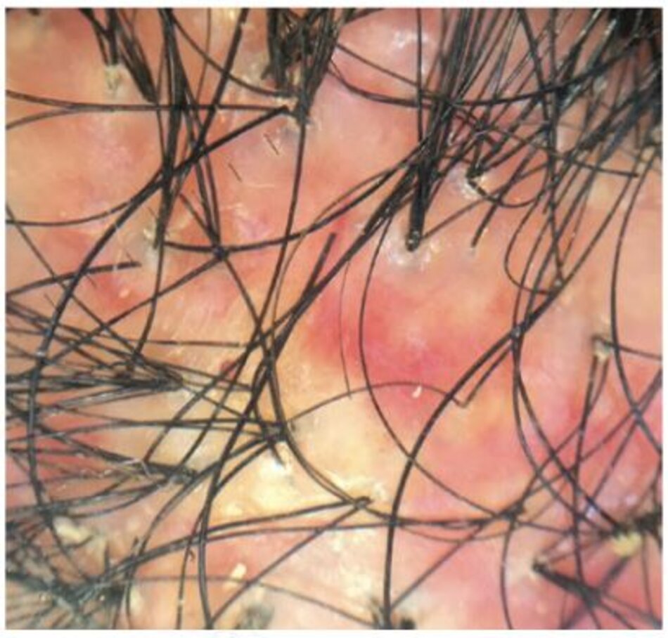 Hình 1.10 Viêm nang lông decalvans: vùng sinh thiết được chọn trong một vị trí có chứa các cụm tóc lớn (> 5 sợi tóc) được bao quanh bởi các vảy