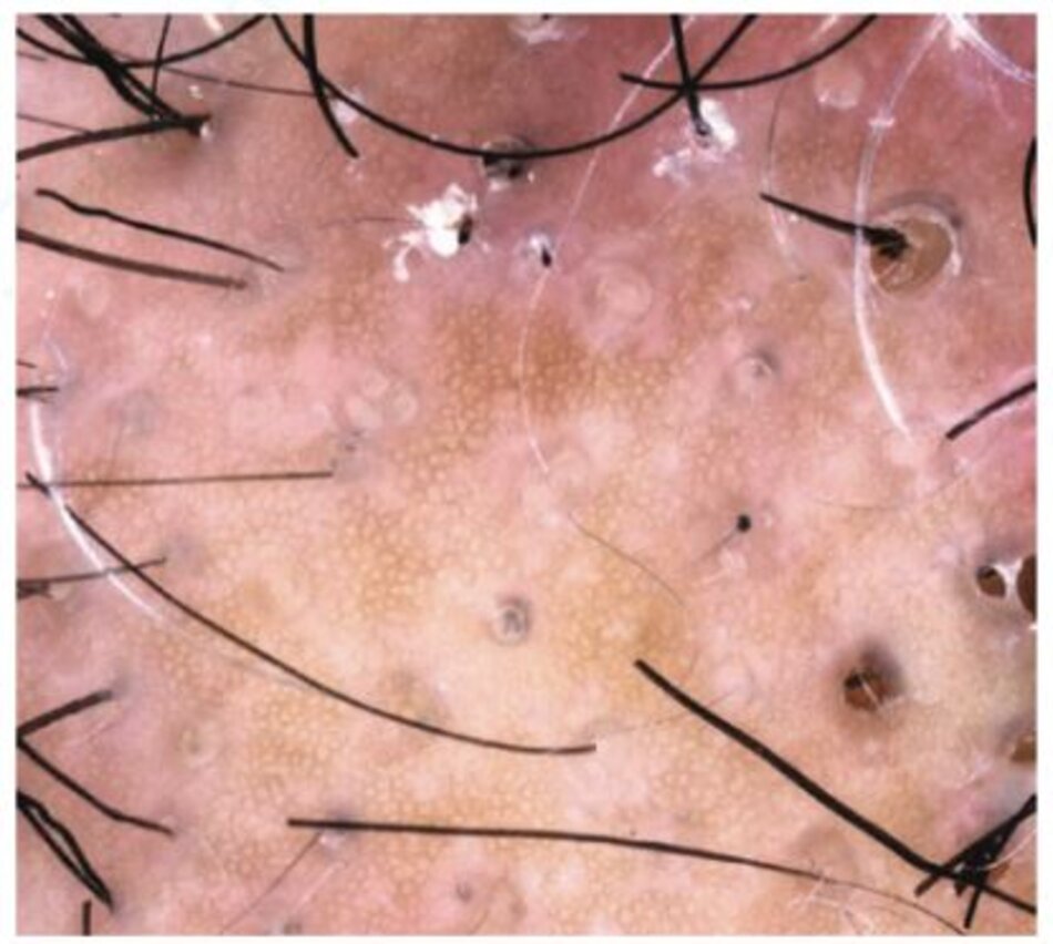 Hình 1.11 Viêm mô tế bào bóc tách (Dissecting cellulitis): tổn thương sớm của viêm mô tế bào bóc tách cho thấy các nút dày sừng, tóc gãy và các chấm đen trên nền ban đỏ; các đặc điểm chỉ ra vị trí sinh thiết tối ưu