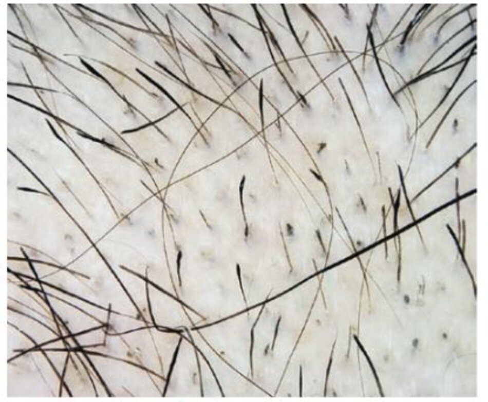 Hình 1.12 Vị trí sinh thiết tối ưu ở một bệnh nhân bị rụng tóc từng mảng cấp tính: tóc dấu chấm than, lông gãy và chấm đen