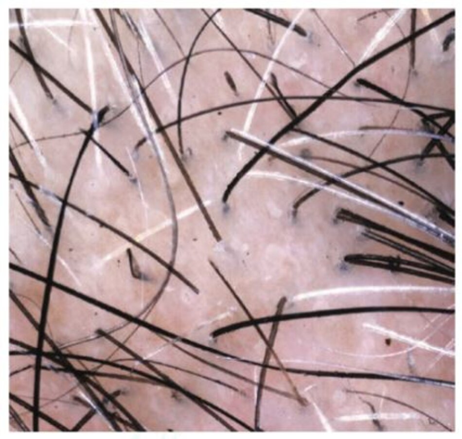 Hình 1.14 Tật nhổ tóc (Trichotillomania): vị trí sinh thiết chứa các sợi tóc bịgãy và các chấmđen. Bệnh nhân này cũng có một số chấm bẩn, thường thấy ở trẻ em và người già