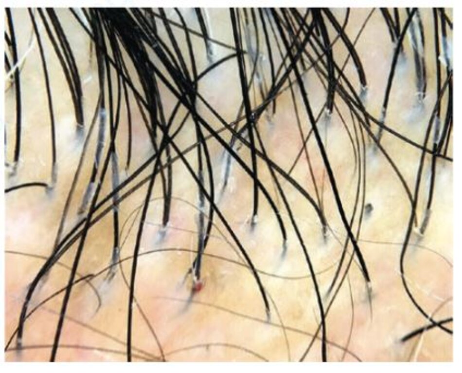 Hình 1.15 Rụng tóc do sức căng (Traction alopecia): các vỏ bao tóc cho thấy sức căng đang hoạt động và chỉ ra một vị trí sinh thiết tốt. Một chấm đen và chảy máu nang tóc là dấu hiệu bổ sung của chấn thương nang