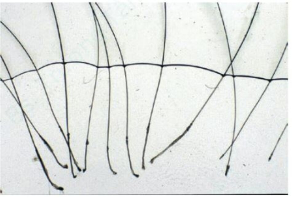 Hình 1.17Phân tích nang tóc bằng kính hiển vi: quan sát thấy trong sợi tóc anagen, nang tóc lớn và có sắc tố rõ, trong khi sợitóc telogen tương tự như một chiếc tăm bông