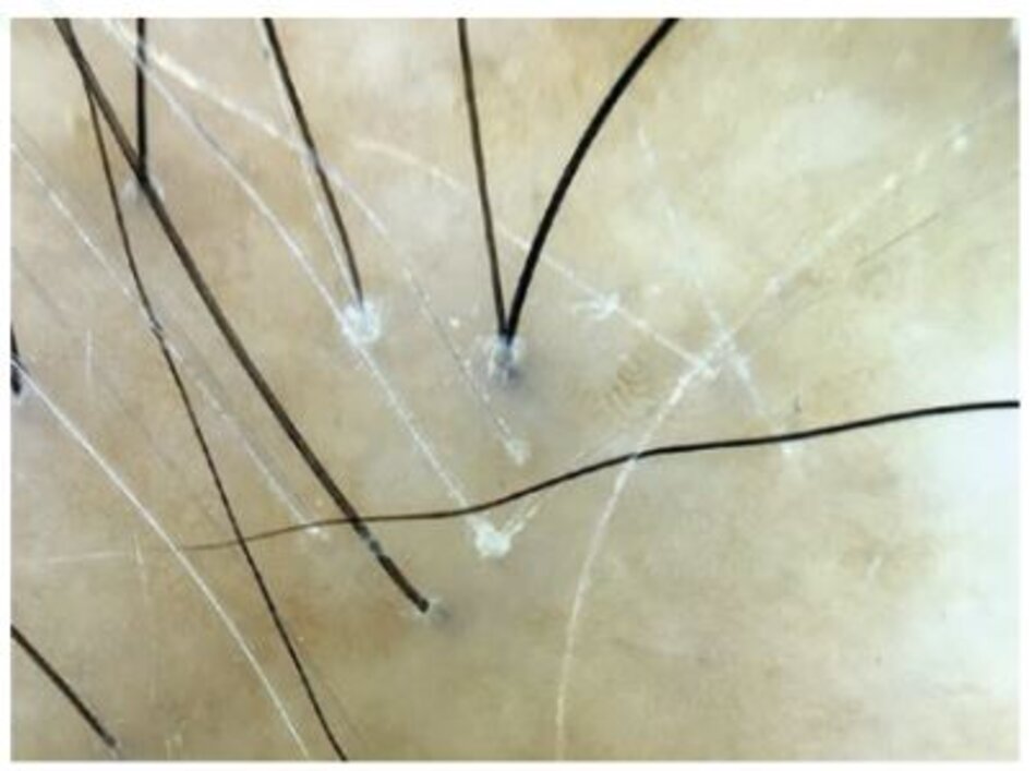 Hình 1.5 Ở những bệnh nhân nghi ngờ có lichen planopilaris, vị trí sinh thiết phải chứa các sợi lông có vảy/ vỏbao quanh nang hoặc các chùm nhỏ được bao quanh bởi vỏ bao