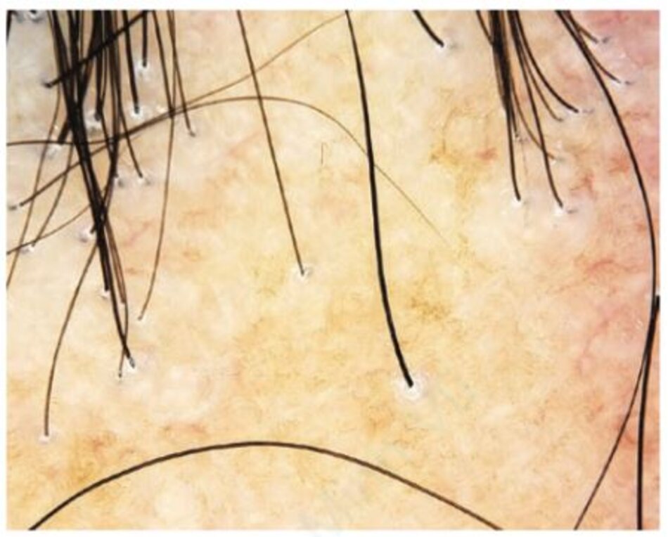 Hình 1.6 Rụng tóc xơ hoá vùng trán (Frontal fibrosing alopecia): các sợi tóc terminal với vảy đồng tâm