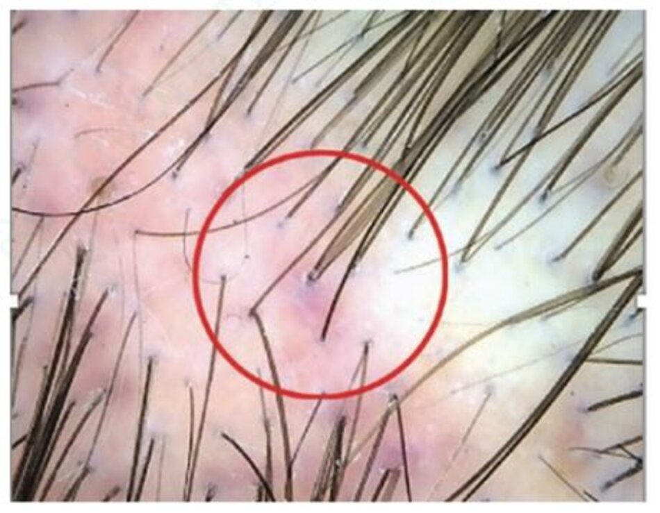 Hình 1.7Rụng tóc phân bố theo vùng (Fibrosing alopecia in a pattern distribution): tìm các nhúm tóc nhỏ có vảy đồng tâm và đôi khi có ban đỏ ở vị trí có sự thay đổi thân tóc