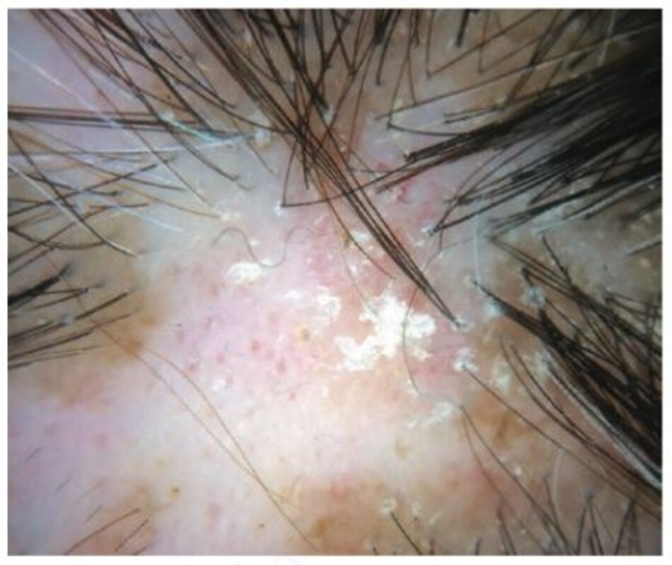 Hình 1.8 Trong bệnh lupus dạng đĩa, chọn một vị trí có các nút dày sừng và/hoặc chấm đỏ, như hình minh họa