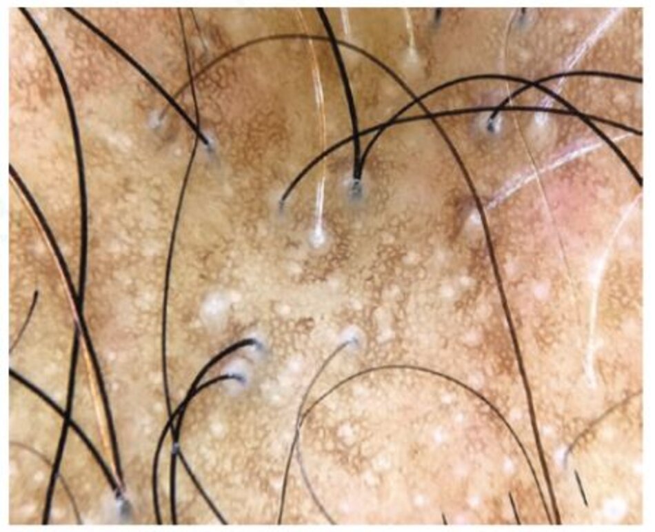 Hình 1.9 Trong rụng tóc lan toả có sẹo trung tâm(Central centrifugal cicatricial alopecia) vị trí được chọn phải chứa các sợi tóc được bao quanh bởi quầng trắng/xám như được thấy trong hình và/hoặc những sợi tóc bị gãy.