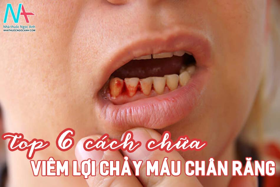 Top 6 cách chữa viêm lợi chảy máu chân răng