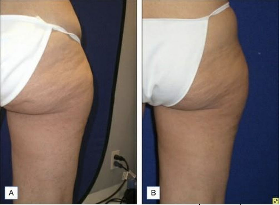 Một phụ nữ 47t (A) trước và (B) sau 6 tháng điều trị với thiết bị VelaShape . Photos courtesy of Neil S. Sadick, MD.