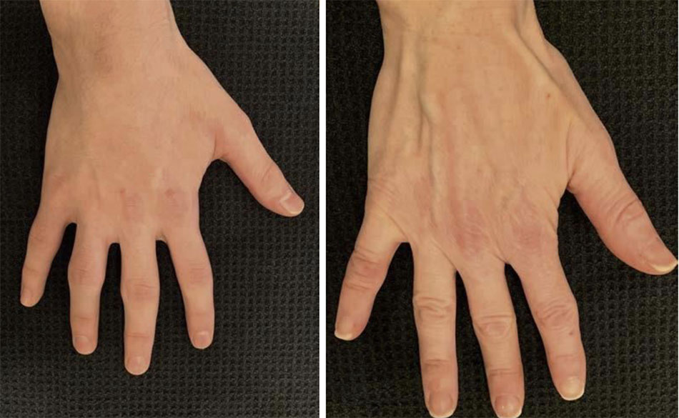 So sánh tay “trẻ” bên trái với tay “trưởng thành” bên phải. Các đường tĩnh mạch ,gân nổi rõ và da sần xùi là đặc điểm của bàn tay lão hóa.
