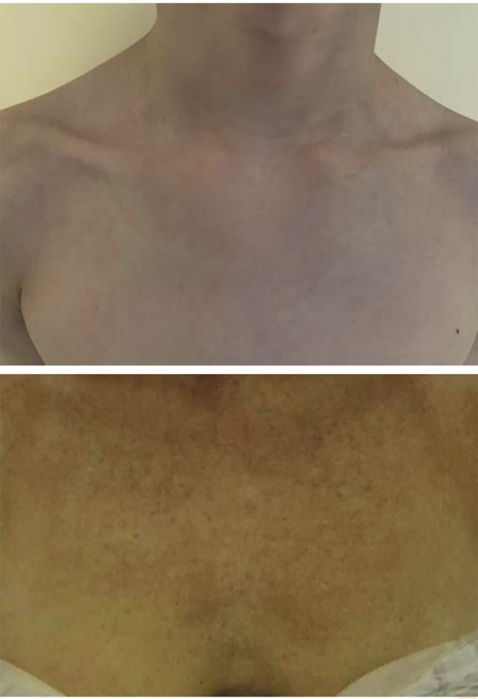 So sánh ngực “trẻ trung” (trên) với ngực “trưởng thành” (dưới) cho thấy những thay đổi do lão hóa, ánh nắng mặt trời và các yếu tố môi trường.