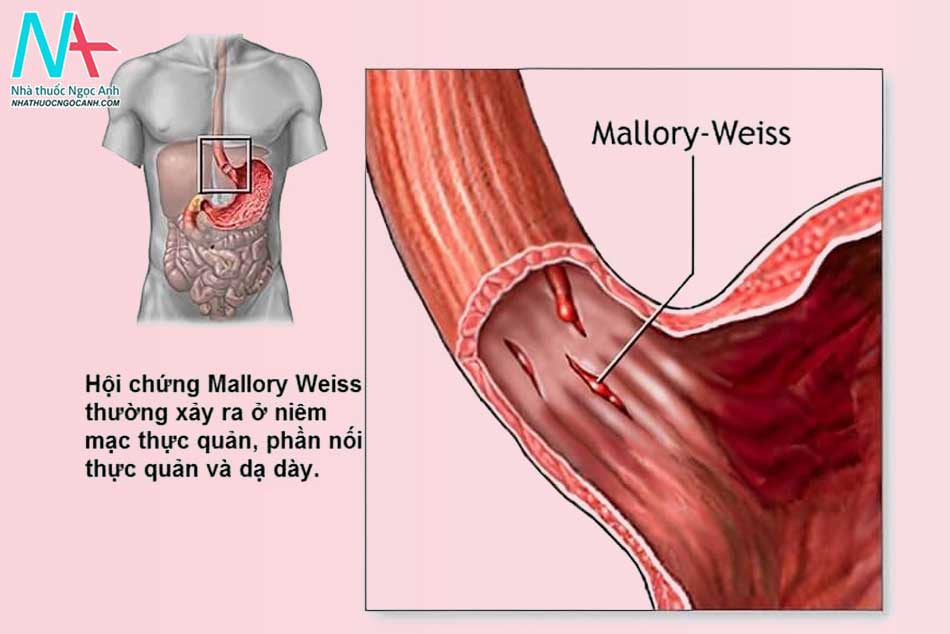 Nguyên nhân hội chứng Mallory Weiss