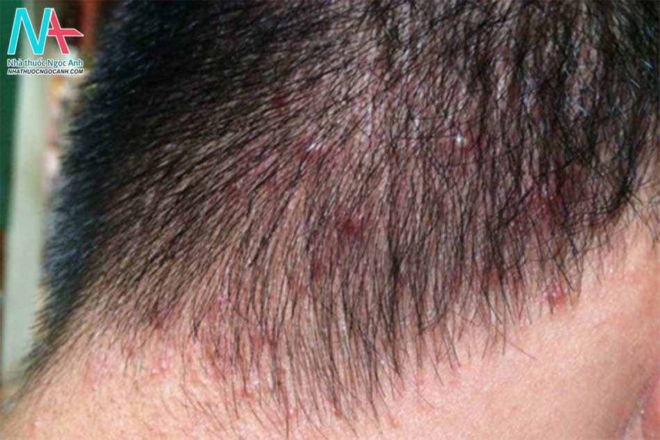 Biểu hiện của nấm da đầu
