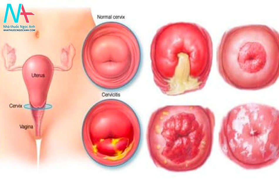 Viêm cổ tử cung có thể gặp phải ở nhiều đối tượng, đặc biệt là nữ giới trong độ tuổi sinh sản