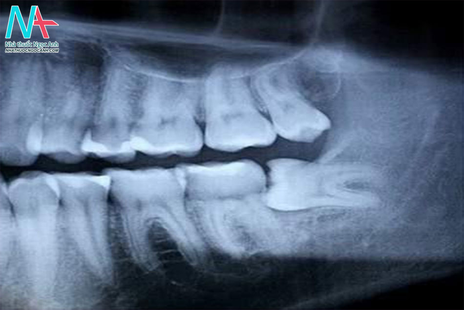 Hình ảnh chụp X-quang của răng khôn