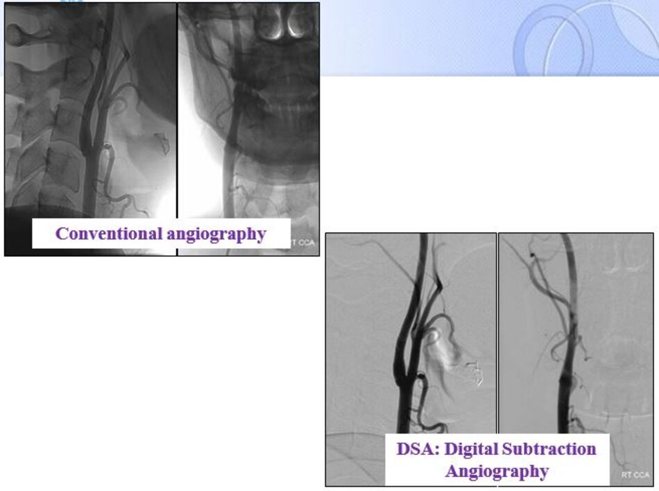 Conventional angiography DSA: Digital Subtraction Angiography