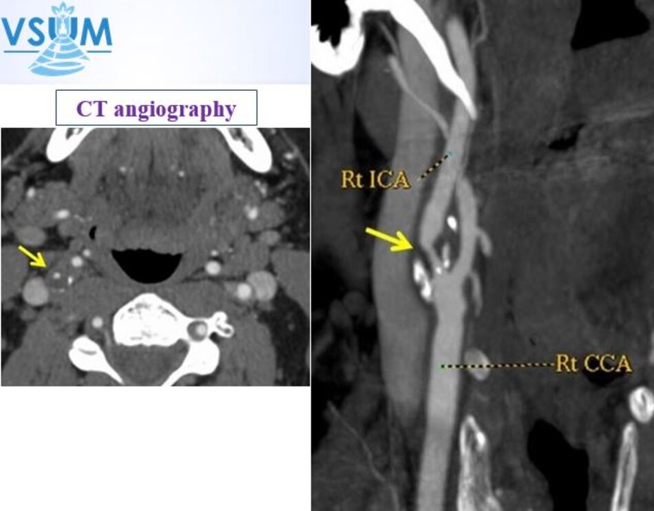 CT angiography