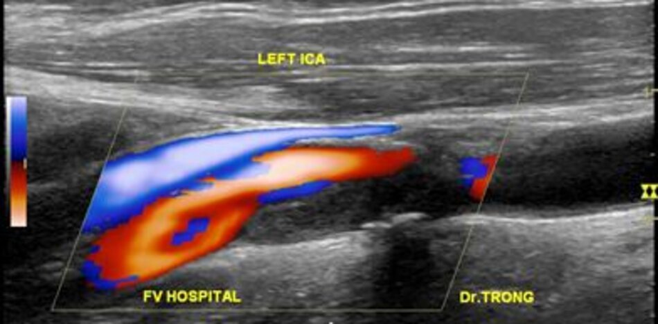 Đặt cửa sổ dọc theo đoạn hẹp, chọn giá trị Doppler xung cao nhất.