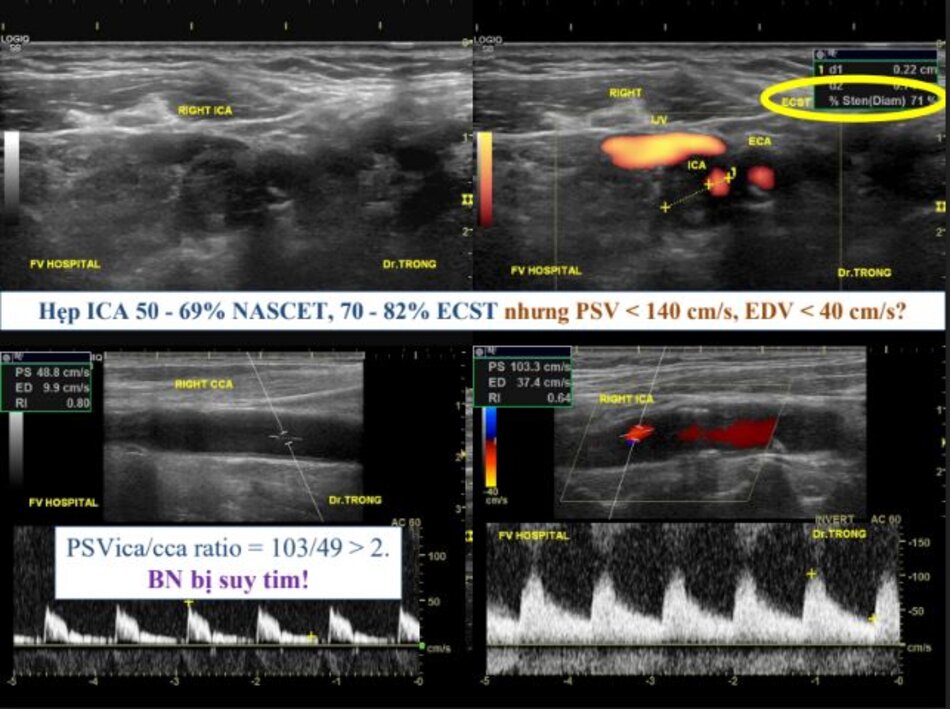 Hẹp ICA 50 - 69% NASCET, 70 - 82% ECST nhưng PSV < 140 cm/s, EDV < 40 cm/s?