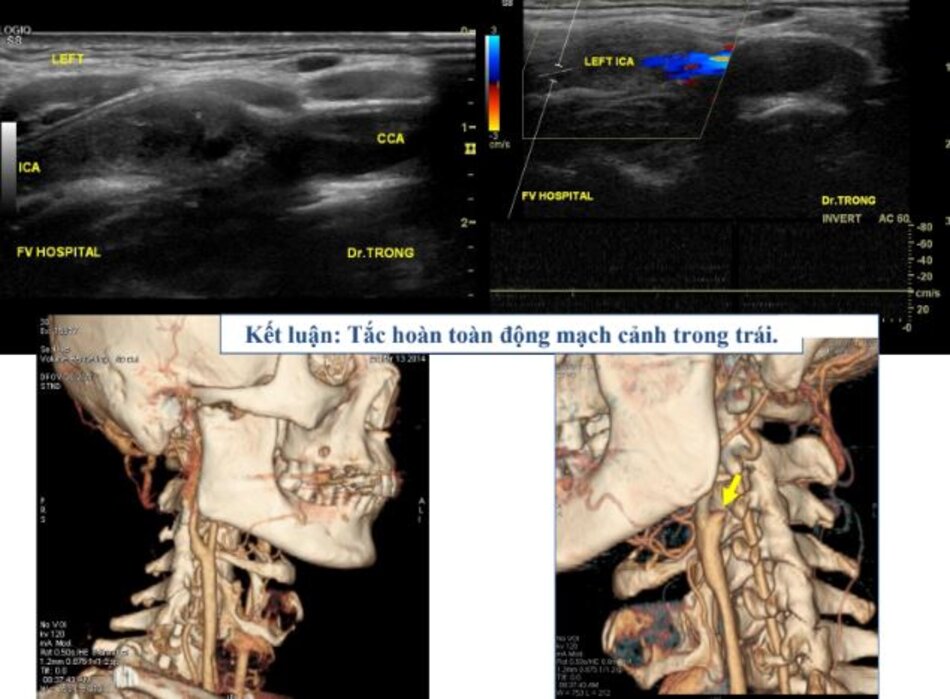 Tắc hoàn toàn động mạch cảnh trong trái