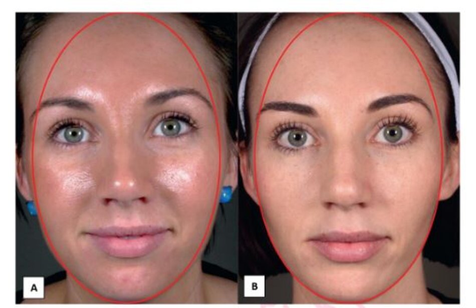 HÌNH 3.3 Hình dạng khuôn mặt trước (A) và sau (B) giảm cân, cho thấy sự thay đổi từ tròn sang bầu dục.