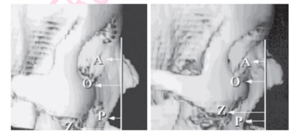 Hình 3.4: Các khu vực của khung xương mặt bị tiêu xương một cách chọn lọc với quá trình lão hóa, với kích thước của các mũi tên cho thấy xu hướng tiêu xương tương đối