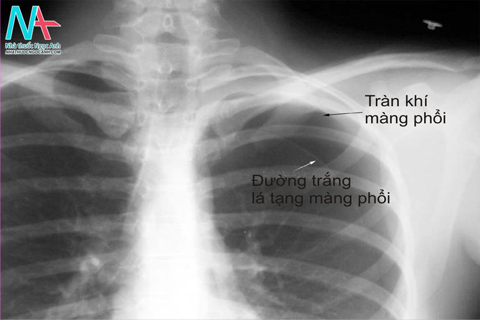 Hình ảnh chụp X-quang của tràn khí màng phổi