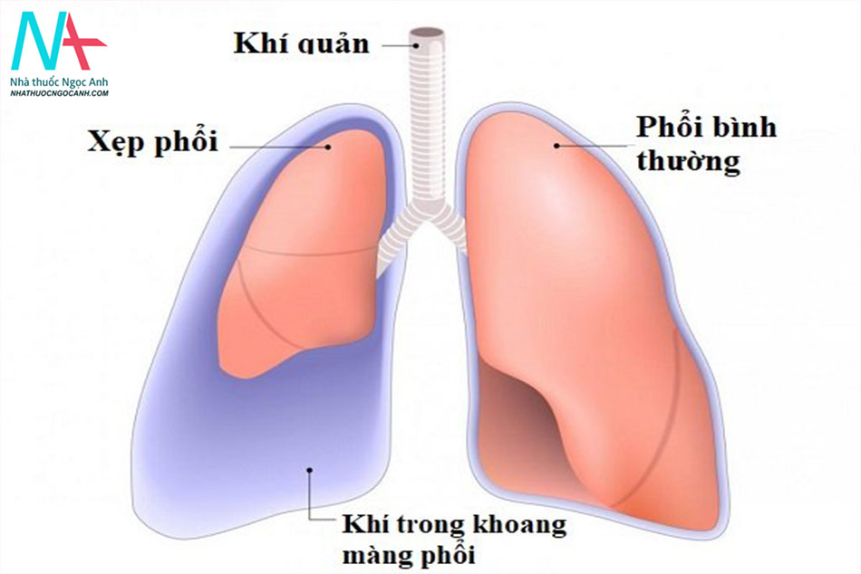 Triệu chứng của bệnh tràn khí màng phổi