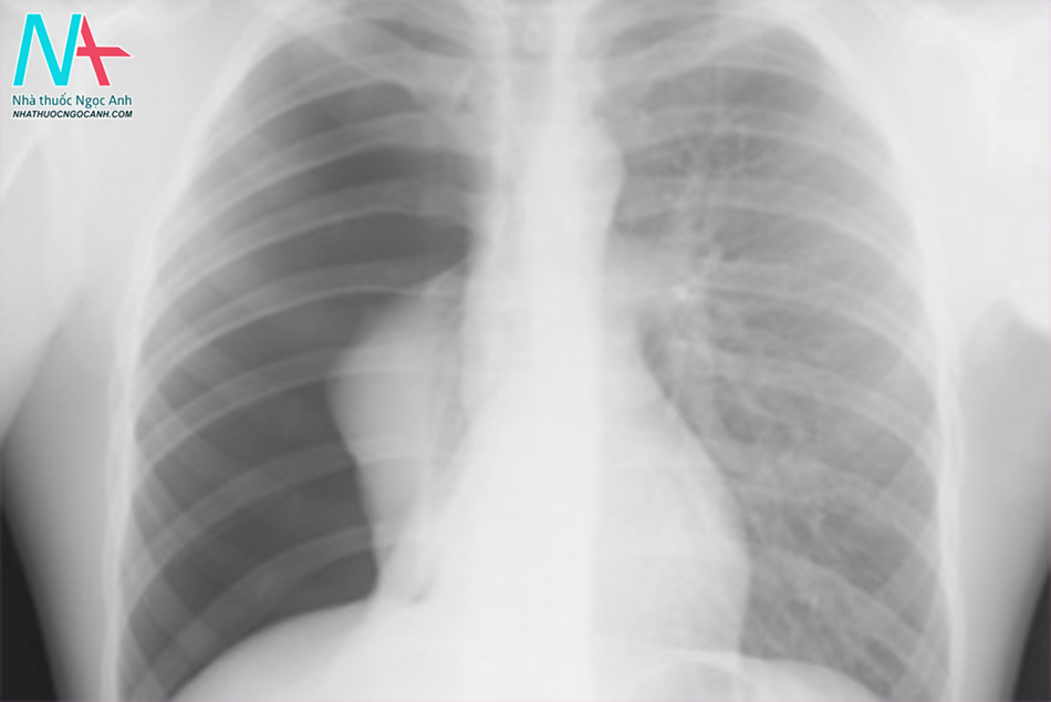 Hình ảnh chụp X-quang của tràn khí màng phổi áp lực