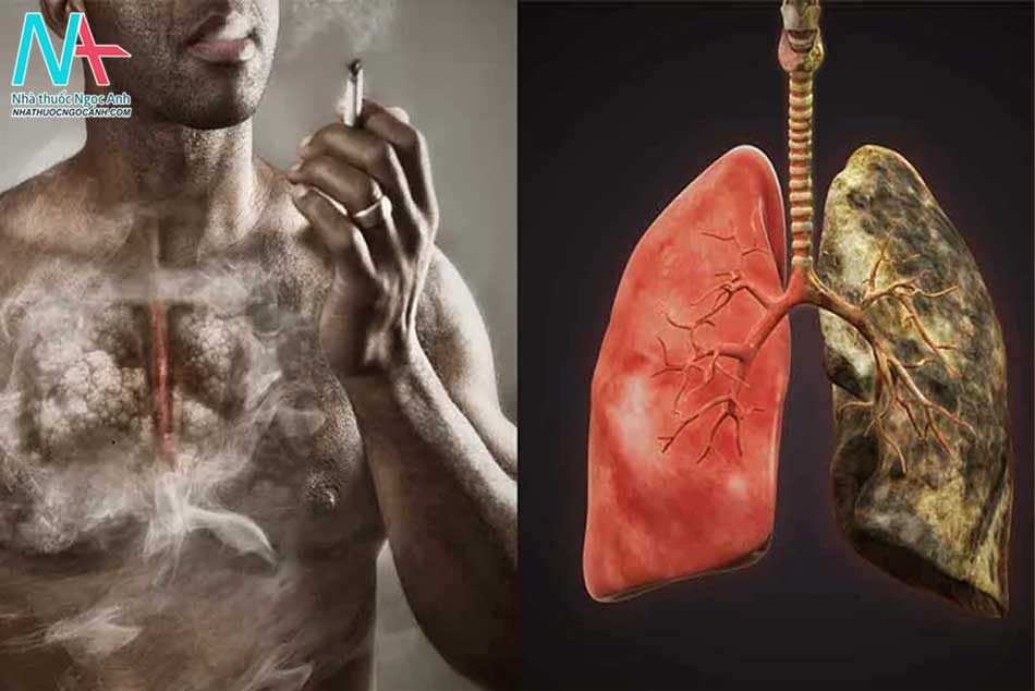 Hút thuốc là nguyên nhân chính dẫn đến ung thư phổi