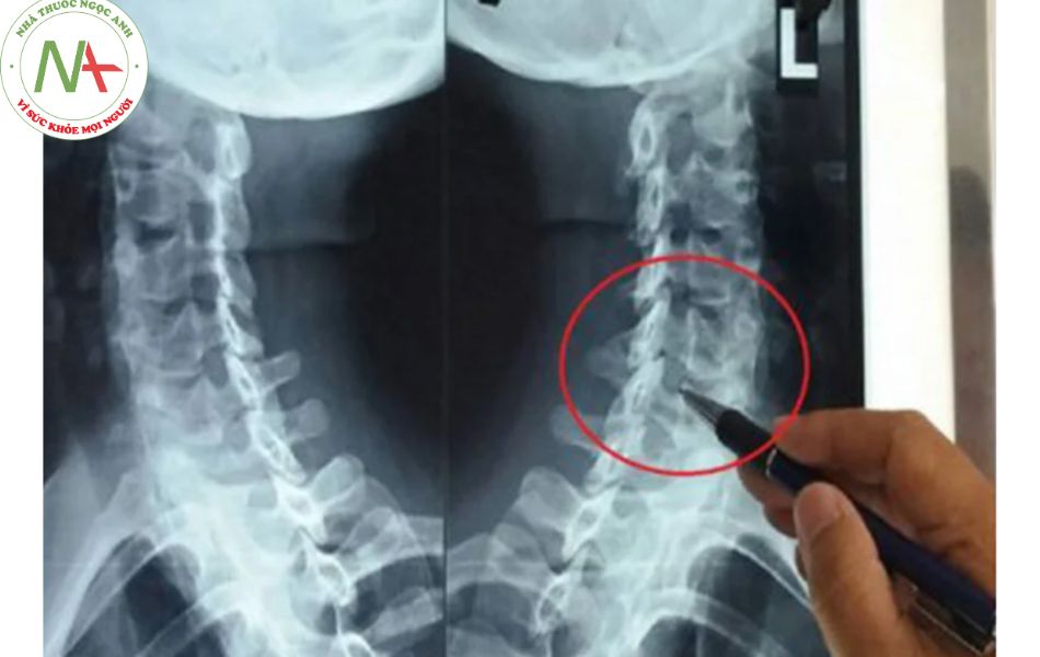 Chụp X-quang để chẩn đoán Thoái hóa đốt sống cổ