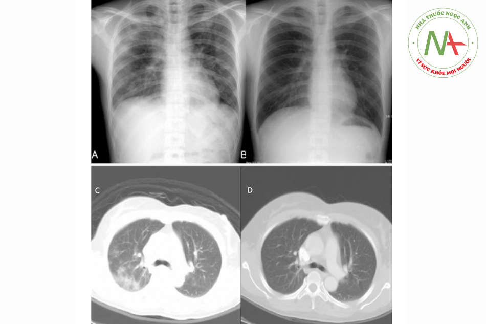 Hình. X-quang ngực:(A) Khi vào cho thấy nhiều vùng tăng mật độ không đồng nhất, rải rác ở cả thùy trên và thùy dưới và (B) sau 1 tháng cho thấy các vùng mờ đã biến mất. Chụp cắt lớp vi tính lồng ngực: (C) Khi vào cho thấy mờ đa ổ, nốt mờ dạng kính mờ ở phổi phải và thùy trên bên trái và (D) sau 1 tháng sau cho thấy tổn thương đã biến mất