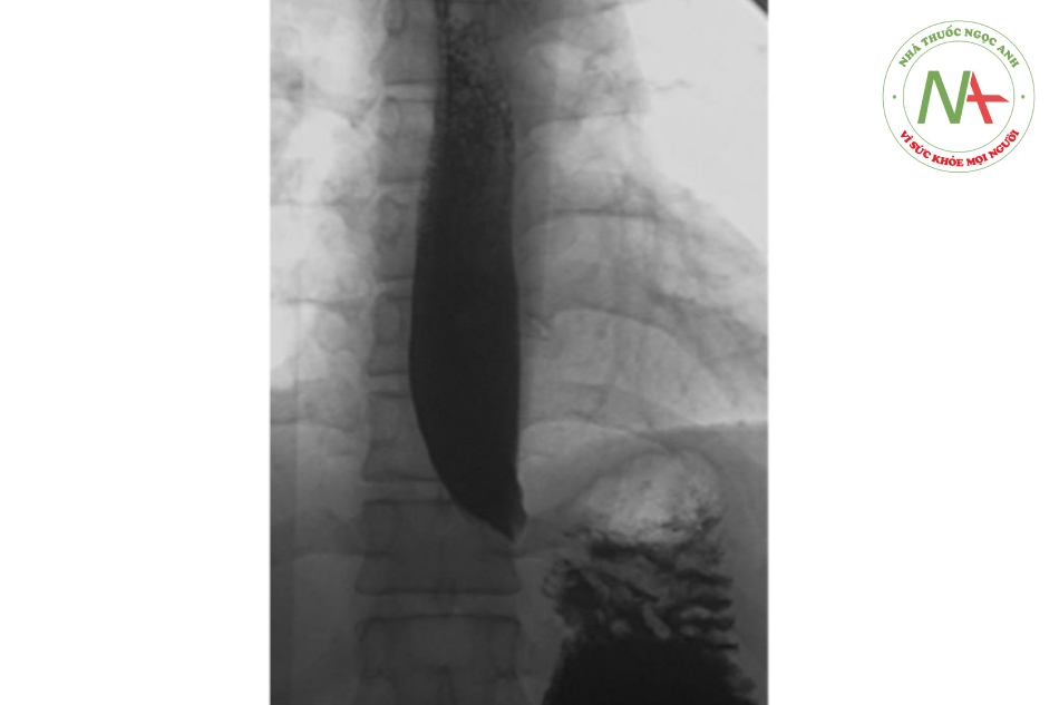Barium esophagogram của bệnh nhân