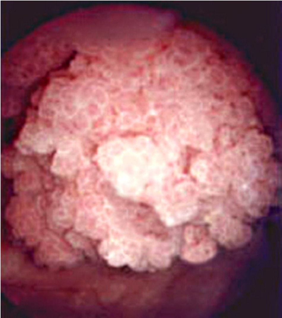 Hình 1: Có thể nhìn thấy khối u bàng quang khi thực hiện nội soi bàng quang