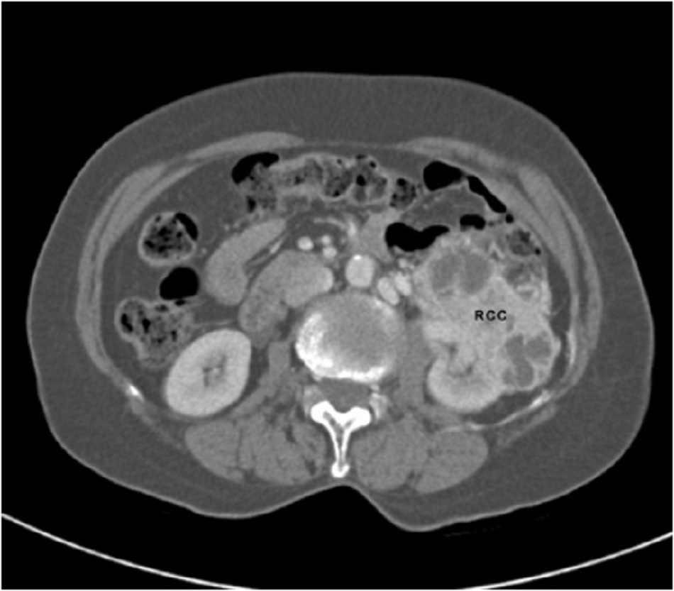Hình 2: CT ung thư biểu mô tế bào thận (RCC) của thận trái