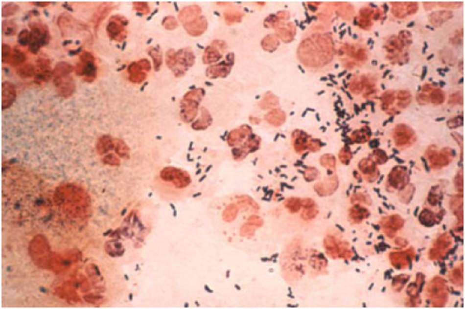 Hình 1: Soi hiển vi mẫu phết trực tràng có nhuộm Gram cho thấy sự xuất hiện của Neisseria gonorrhoeae Gram âm.