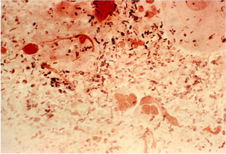 Hình 2: Soi hiển vi mẫu phết trực tràng nhuộm Gram cho thấy sự xuất hiện của cầu khuẩn Neisseria gonorrhoeae Gram âm