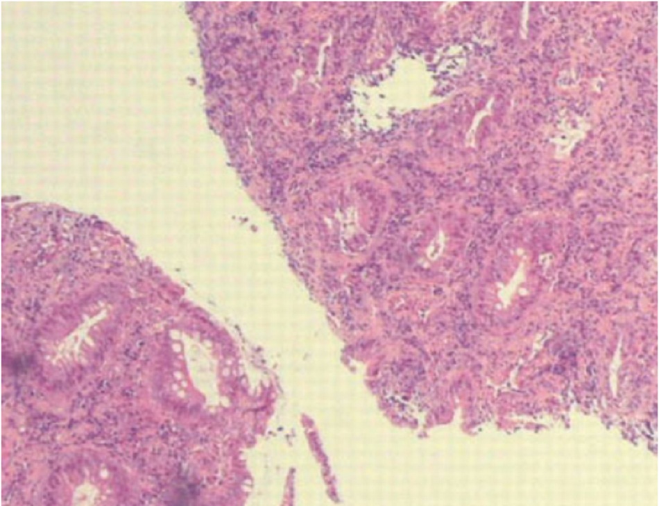 Hình 3: Niêm mạc trực tràng cho thấy viêm mạn tính không đặc hiệu ở bệnh nhân bị bệnh hột xoài (do Chlamydia trachomatis)