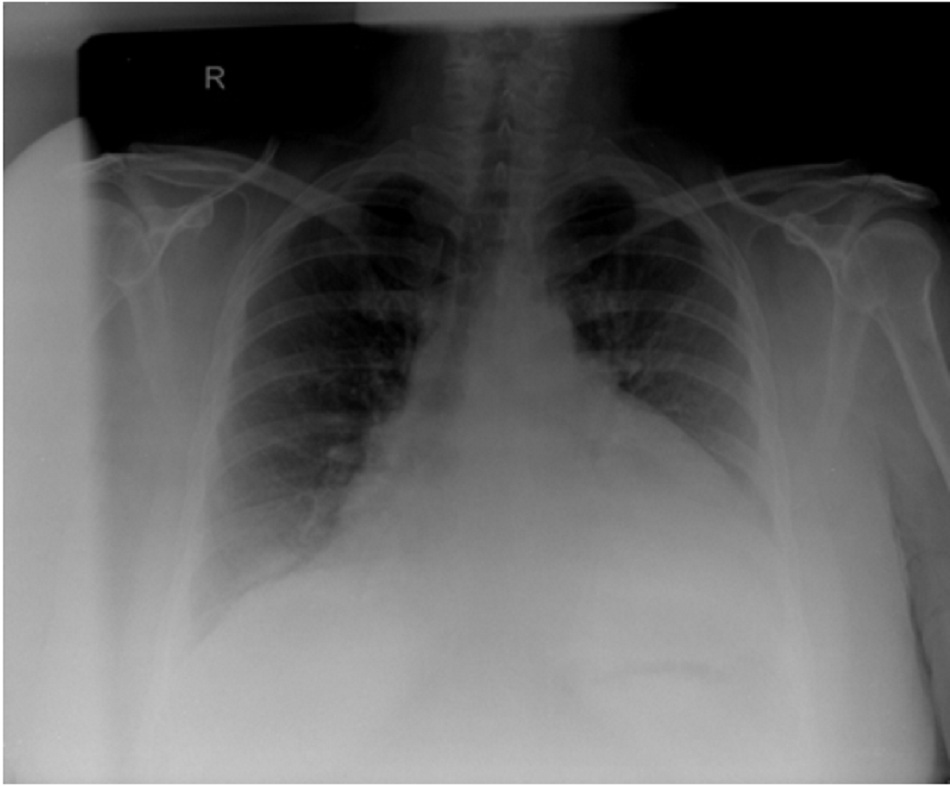 Hình 3 XQ ngực thẳng ở bệnh nhân bị tràn dịch màng ngoài tim cho thấy các phát hiện điển hình về bóng tim hình chai nước với dải mỡ màng ngoài tim, dễ nhận thấy