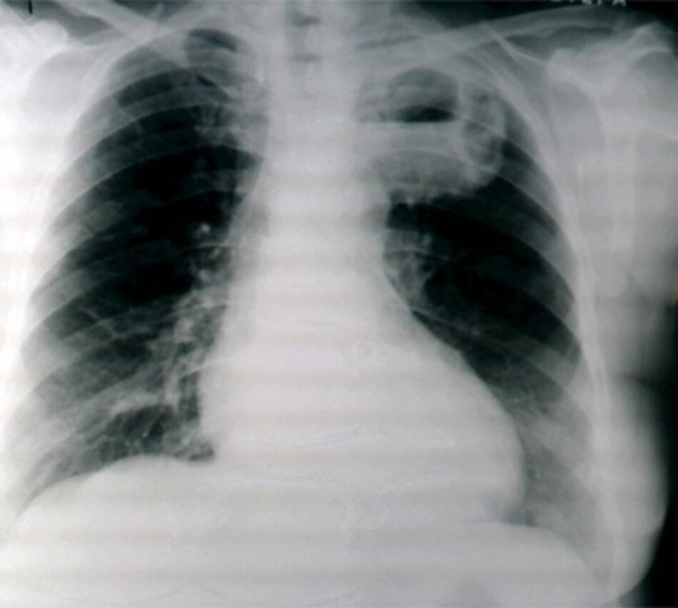 Hình 1: CXR chỉ ra áp-xe phổi ở thùy trên bên trái. Từ thông tin thu thập của Bác sĩ Ioannis P. Kioumis