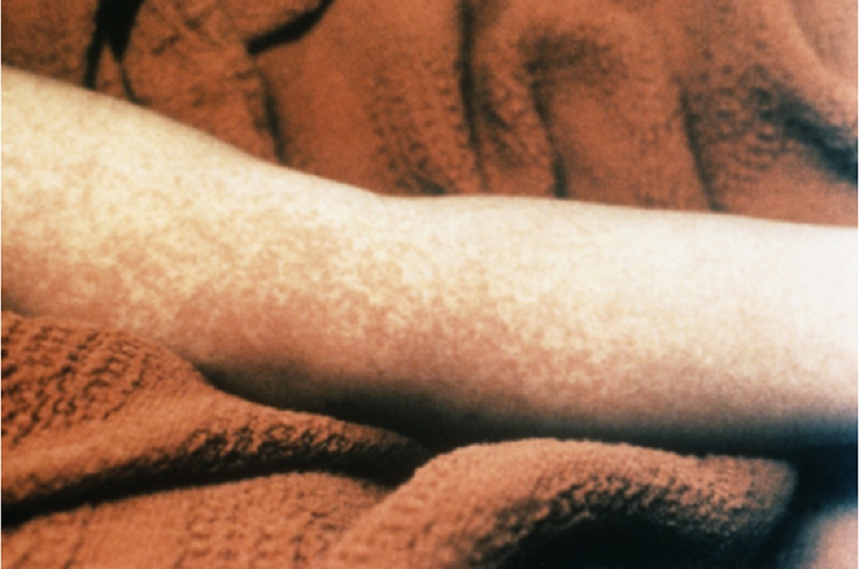 Hình 10: Phát ban dạng sởi (giống bệnh sởi) do hội chứng sốc nhiễm độc