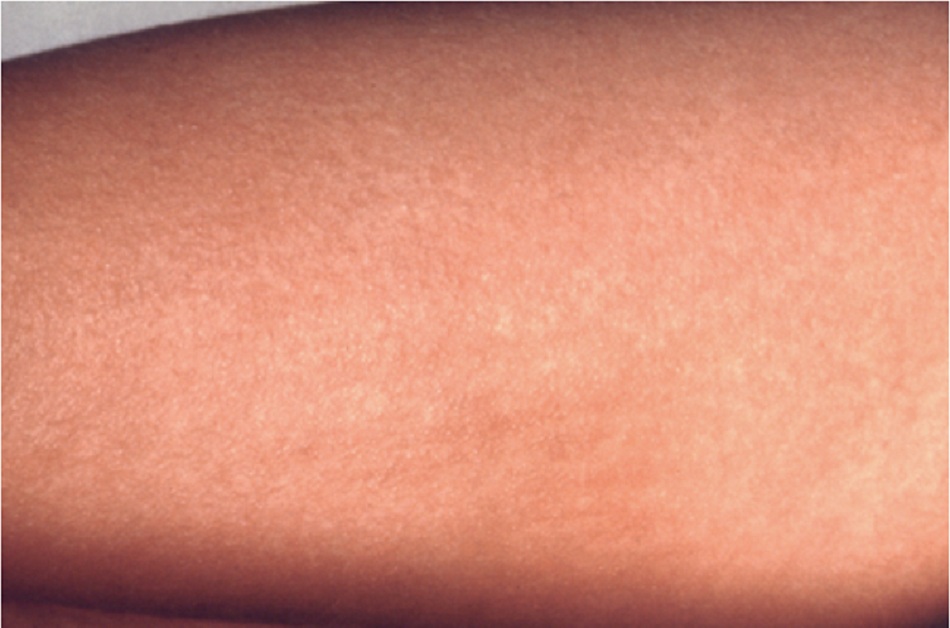 Hình 11: Phát ban sốt scarlet trên cánh tay do vi khuẩn liên cầu khuẩn nhóm A