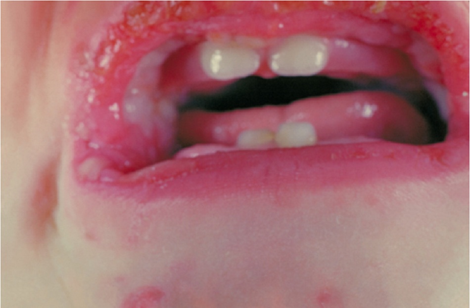Hình 4: Ban đỏ đa dạng kèm theo loét quanh miệng