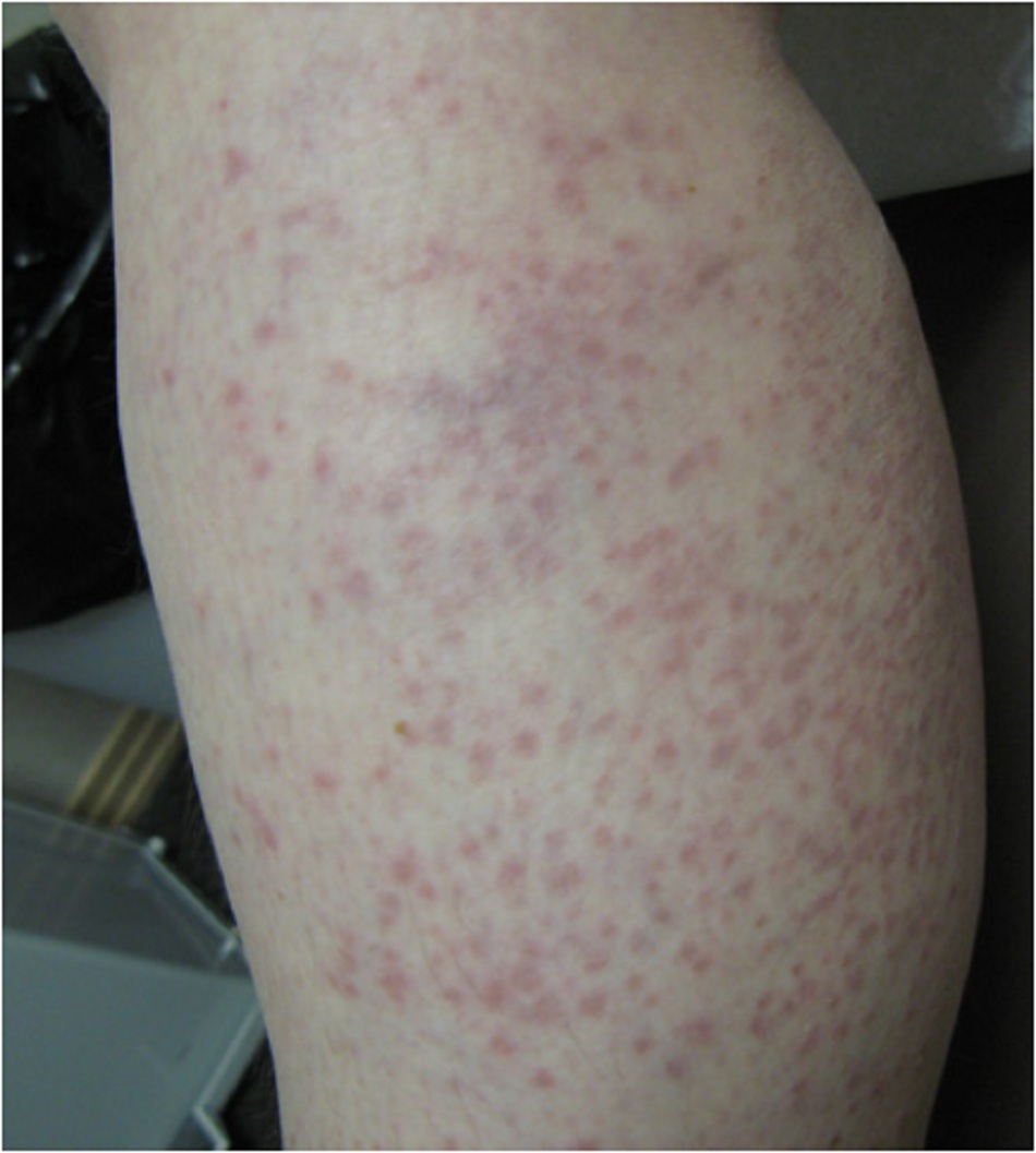 Hình 6: Ngoại ban do vi-rút biểu hiện là phát ban sần. Ghi nhận nốt sẩn ban đỏ lớn hơn vết ban ở chân của người trẻ tuổi