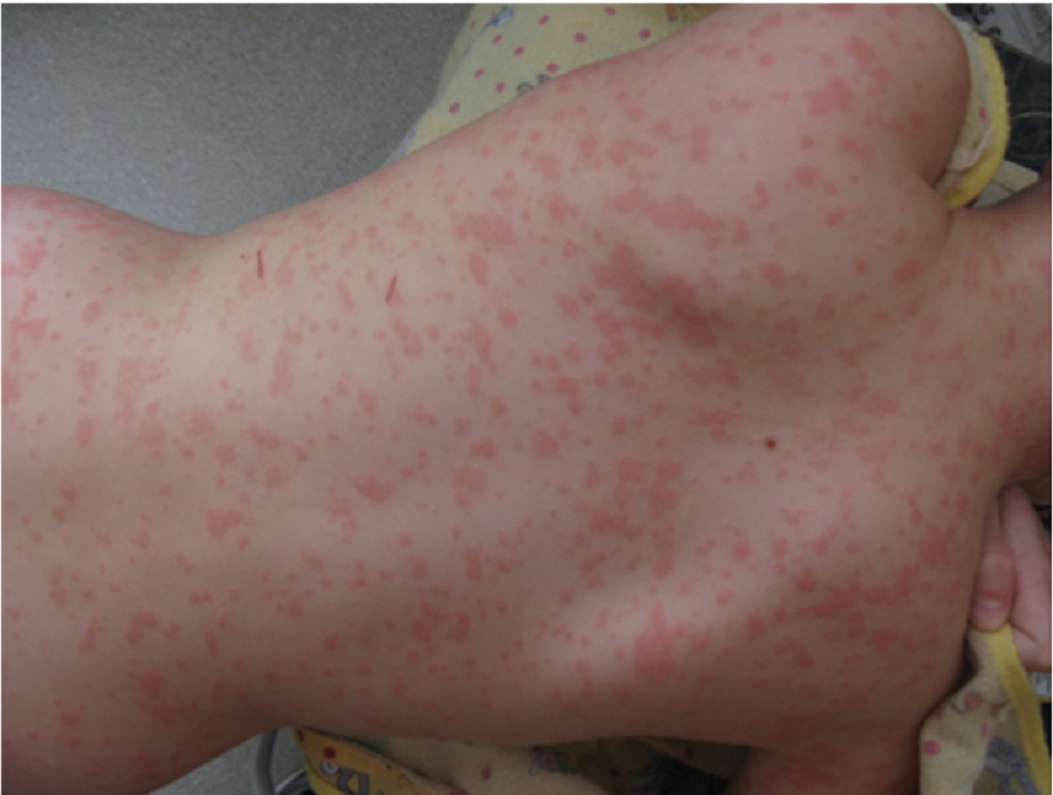 Hình 7: Ban đỏ nhiễm khuẩn (bệnh thứ năm) ở bé gái 10 tuổi