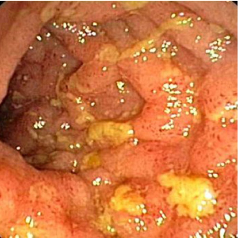 Hình 1: Hình ảnh nội soi viêm hồi tràng Crohn