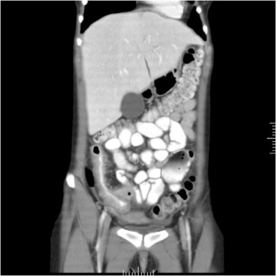 Hình 4: Chụp CT cho thấy dày đoạn cuối hồi tràng ở bệnh nhân bị bệnh Crohn trở nặng