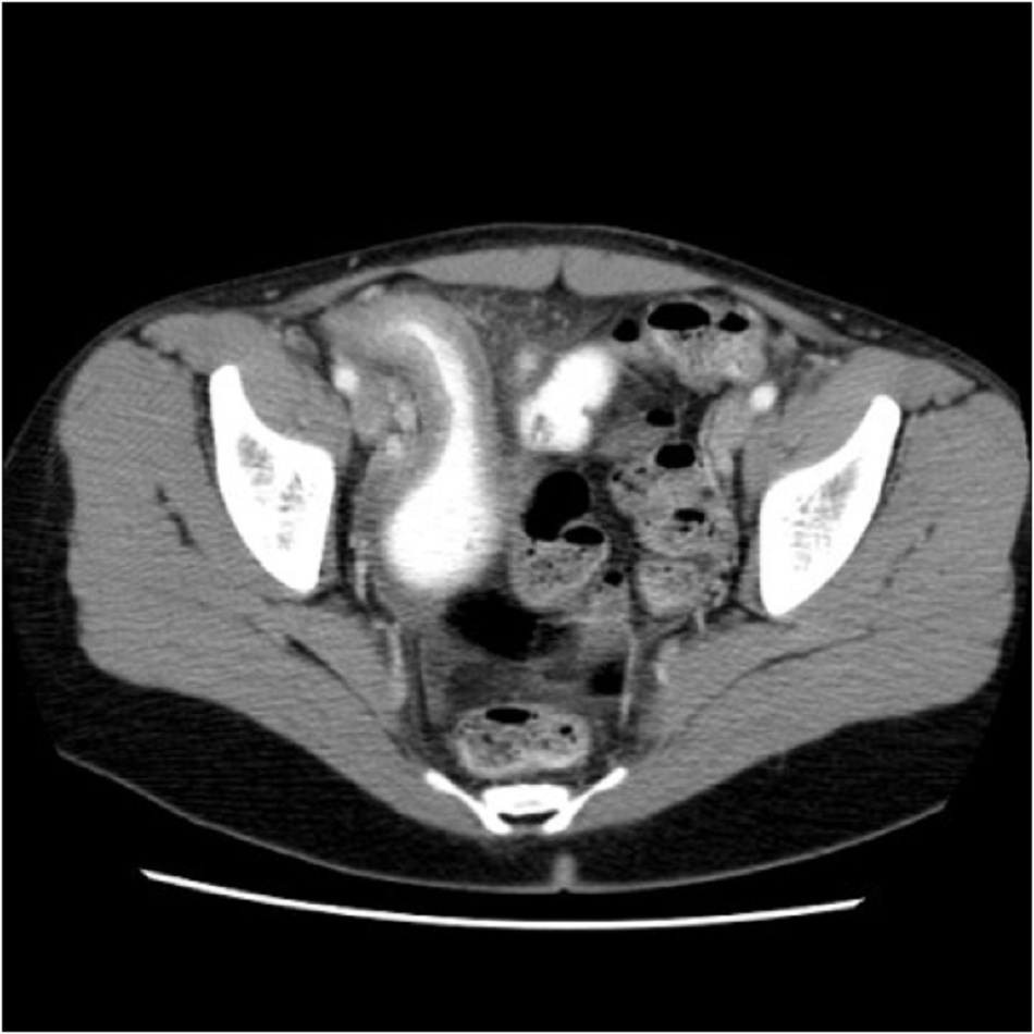 Hình 5: Chụp CT cho thấy dày đoạn cuối hồi tràng ở bệnh nhân bị bệnh Crohn trở nặng