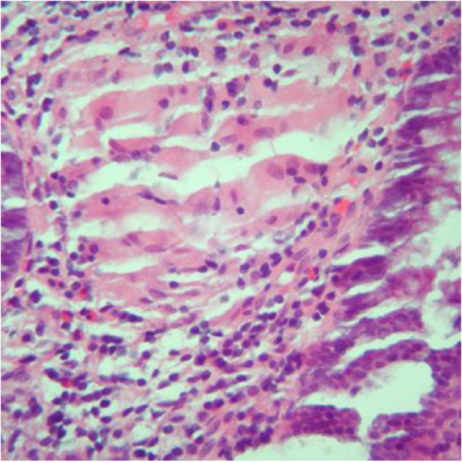 Hình 7: U hạt ở những bệnh nhân bị bệnh Crohn; lưu ý sự kết tụ của mô bào dạng biểu m