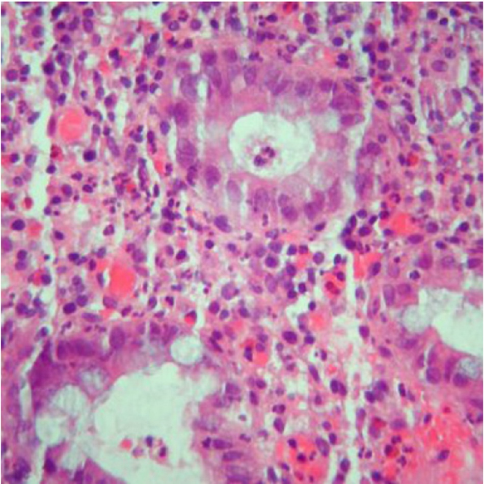 Hình 8: Viêm hốc và áp-xe nang với biến dạng hình thái của nang đi kèm viêm và nhiều tế bào bạch huyết và bào tươn